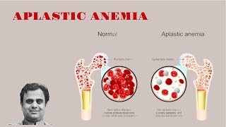 Aplastic Anemia [upl. by Lyman]