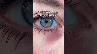 IRIS Heterochromia coloured EYE 👁️ 🧡 eyes rare aesthetic [upl. by Sergio477]