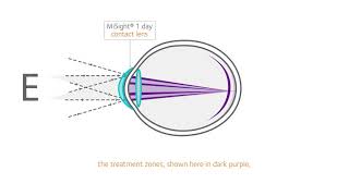 How does MiSight work [upl. by Sualkcin]