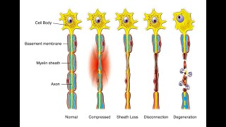 Degrees 1 2 3 4 5 of Nerve injury  Axonotmesis and Neurotmesis [upl. by Earissed562]