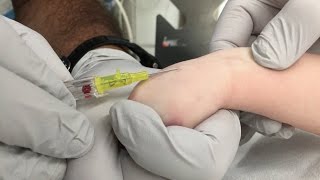 IV Insertion Technique in Infants and Small Children [upl. by Eelyah]