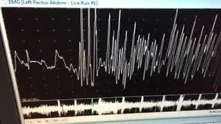 neuromyotonic discharges [upl. by Assert]