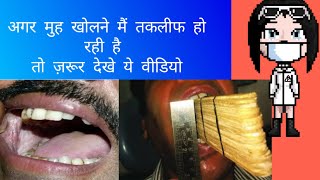 Oral Submucous Fibrosis OSMF in hindi  Kya ye cancer hota hai  Treatment  Cause [upl. by Frymire]