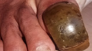 Extreme Toenail Transformation Cutting Wild amp Smelly Toenails [upl. by Civ]