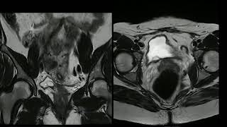 Miomas e ureterocele [upl. by Kolk]