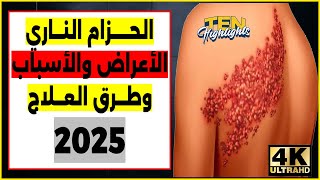 الحزام الناري الأعراض والأسباب وطرق العلاج 2025 [upl. by Ongun]