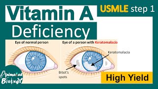 Vitamin A deficiency  xerophthalmia  Keratomalacia  nyctalopia  Phrynoderma  USMLE step1 [upl. by Sitelc]