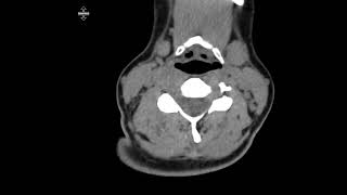 Mediastinal duplication cyst [upl. by Eudo727]