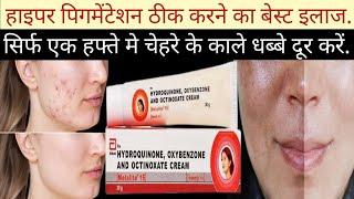 Melalite 15 cream ke Fayde Melalite 15 Cream Uses in Hindi Melalite skin cream [upl. by Namilus]