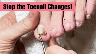 Fixing Toenails that Change Shape and Color [upl. by Willem]