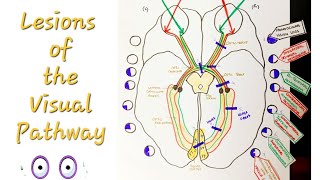 Lesions of the Visual Pathway  Optic Nerve and pathway lesions [upl. by Roslyn]