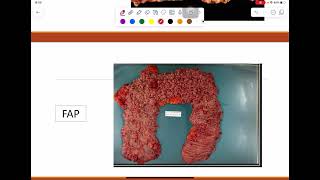 General pathology lab  Neoplasia part 2 [upl. by Meela]