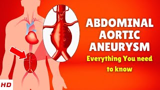 Abdominal aortic aneurysm – Causes Signs and Symptoms Diagnosis amp Treatment [upl. by Tolmann739]