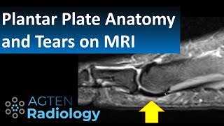 How to assess plantar plate anatomy and tears on MRI [upl. by Acnaib]