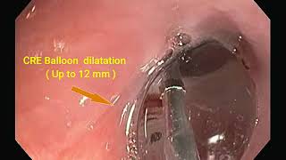 Anastomotic Stricture  Post  op case of Ca Oesophagus   CRE Balloon Dilatation [upl. by Leirum]