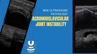 Acromioclavicular joint instability seen on diagnostic ultrasound [upl. by Yseulta]