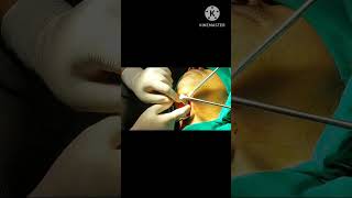 ગળાની રસોળી નું ઓપરેશન गले में गठानthyroglossal cyst removal under local anaesthesiatruptient [upl. by Jahdiel]