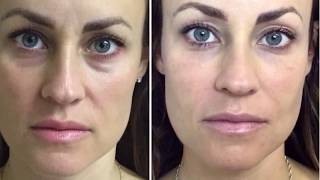 Dermal Filler Under Eyes Tear Trough [upl. by Atteram]