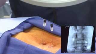 WATCH an Epidural Steroid Injection Demonstration  LIVE [upl. by Shute306]