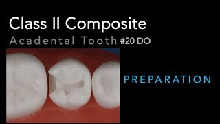 Class II Composite Preparation  Acadental Tooth 20 DO [upl. by Wachter]