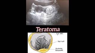 Teratoma  Ovary  Ultrasound  Radiology [upl. by Grissom]