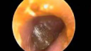 Acute Otitis media tympanic blister [upl. by Scheers365]