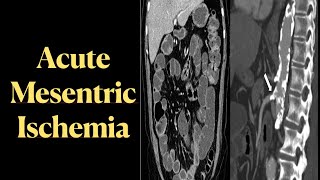 Acute Mesenteric Ischemia AMI [upl. by Gannes]