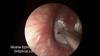 ENDOCSOPIC MUCOID OTITIS MEDIA DRAINAGE [upl. by Zulch]