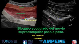 Como bloquear el nervio supraescapular paso a paso con guía de ultrasonido o ecoguiado [upl. by Abehs834]