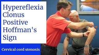 Hyperreflexia Clonus Positive Hoffmans Sign Central Cervical Spine Stenosis [upl. by Columbyne]