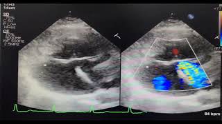 Endocardial Cushion Defect  Rastelli type C [upl. by Nicol]