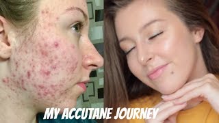 MY ISOTRETINOIN ACCUTANE JOURNEY  BEFORE AND AFTER PHOTOS [upl. by Oznecniv]