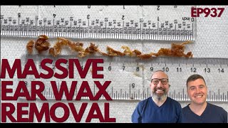 MASSIVE EAR WAX REMOVAL  EP937 [upl. by Nylaret]