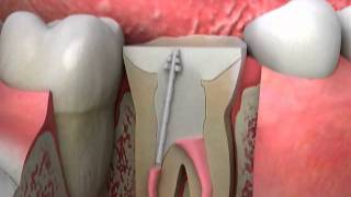 Crowns Post and Core Procedure [upl. by Guibert]