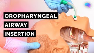 Oropharyngeal Airway Insertion  Guedel  OPA  ABCDE Emergency  OSCE Guide  UKMLA  CPSA [upl. by Sacha]