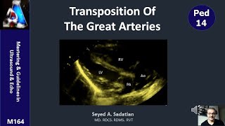 Transposition of the great arteries TGA [upl. by Arakahs226]