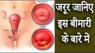 गर्भाशय ग्रीवा शोथ │ यौन संक्रमण रोग │ Cervicitis Symptoms amp Causes [upl. by Esimorp]