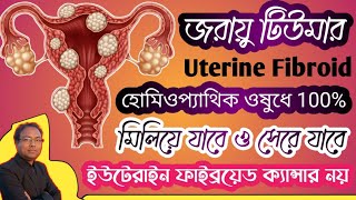 Uterine fibroid homoeopathic medicine  fibroid tumor homoeopathic medicine  jaraur tumor [upl. by Eiramanitsirhc250]