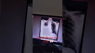 Lung में पानी  pleural effusion [upl. by Dranek]