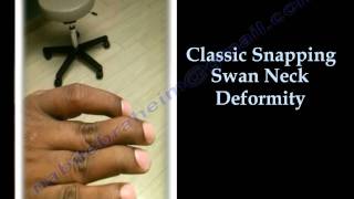 Swan Neck Deformity Classic Snapping  Everything You Need To Know  Dr Nabil Ebraheim [upl. by Shalne]