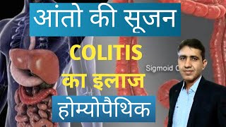 Colitis Treatment in Homeopathy  आंतो की सुजन का इलाज होम्योपैथिक  Badi Aant Ki Soojan Ka Ilaaj [upl. by Amena]