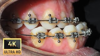 UNDERBITE in adults❗Braces time lapse [upl. by Sajovich]