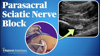 Ultrasound Guided Parasacral Sciatic Nerve Block [upl. by Atteval]