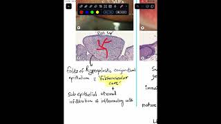 Papillae Vs Follicles in Conjunctiva  Histopathology Shorts [upl. by Eidna]