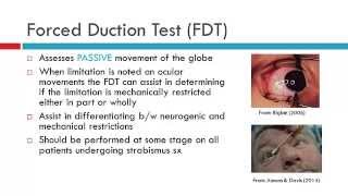 Forced Duction Test amp Force Generation Test [upl. by Ho]