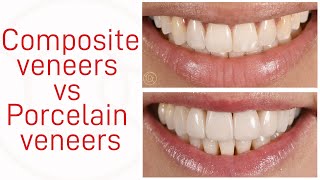 Composite veneers vs Porcelain veneers [upl. by Astraea871]