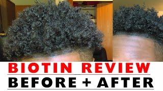 BIOTIN Hair Growth Results Before and After [upl. by Ydniw338]