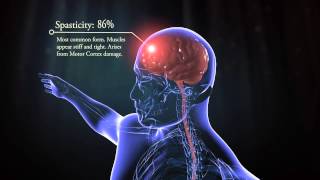 Types of cerebral palsy [upl. by Drue]