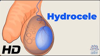 Dealing with Hydrocele Understanding the Condition and How to Manage It [upl. by Nnalyrehs]