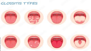 Glossitis benign migratory glossitis geographic tongue [upl. by Scrogan85]